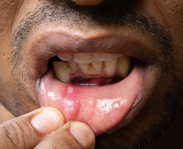 Mouth Ulcers Treatment
